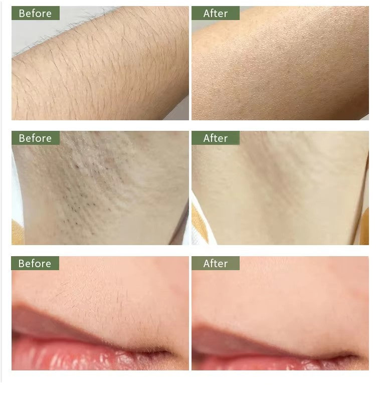 Laser Hair Removal 808 755 1064 Diode Lazer Machine