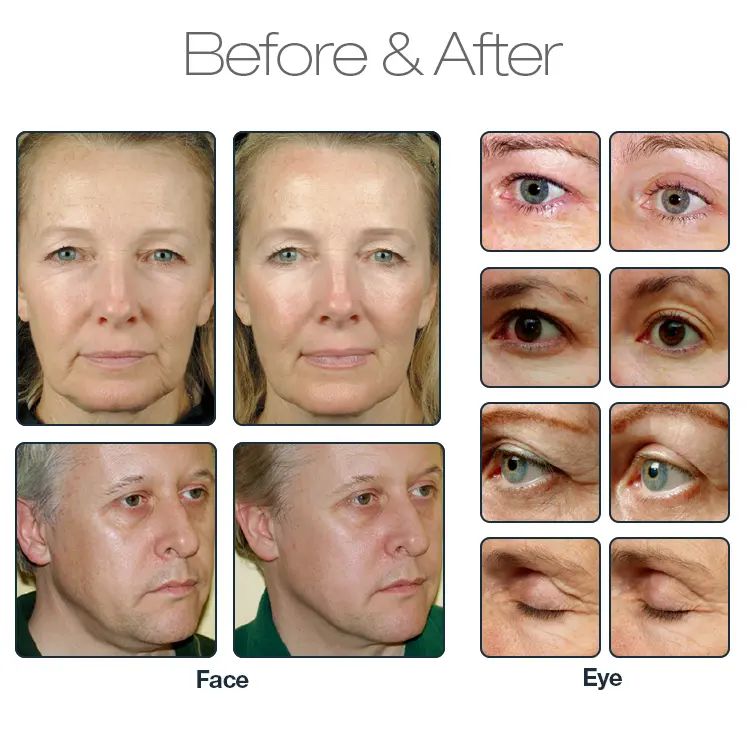 RF Fractional Skin Tightening Dot Matrix Device