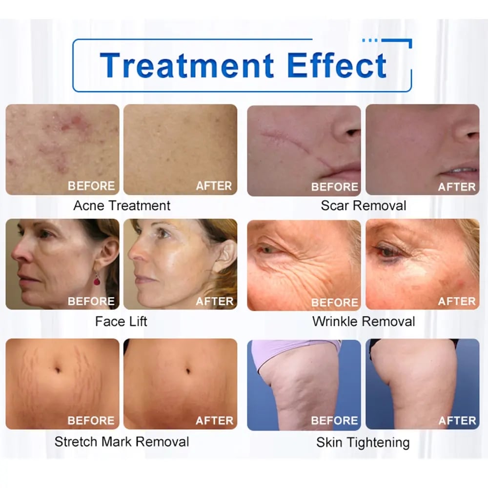 rf microneedling effect