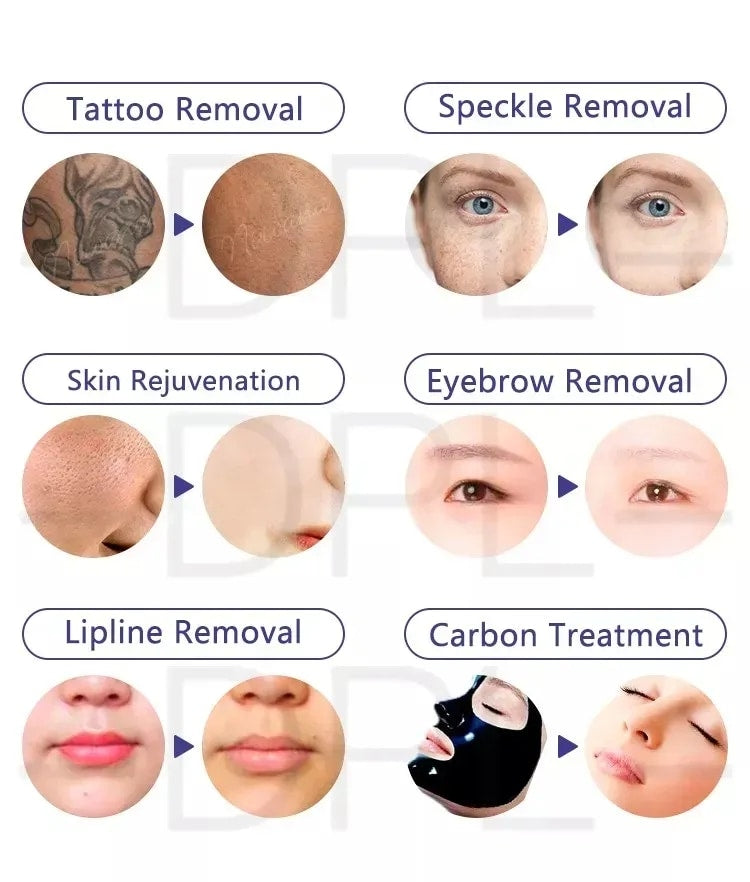 Picosecond Laser Pigmentation & Tattoo Removal Results - Doristek