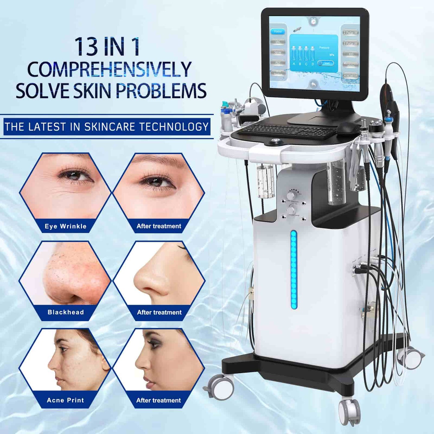 Hydra Dermabrasion Facial Aqua Peel Analysis Machine